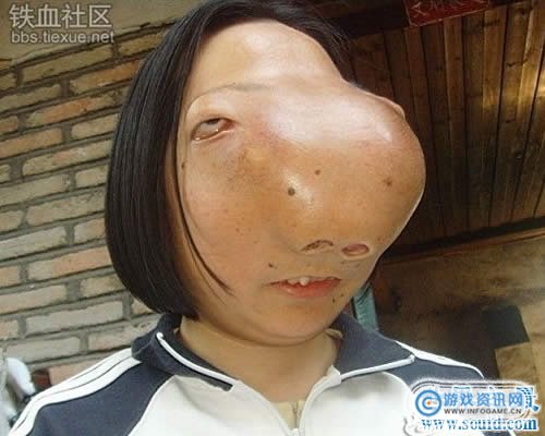 盘点世界上最恐怖怪异的畸形人,恶心畸形儿胆小的勿入!