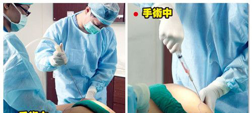 女子做抽脂手术丧命 女子手术抽脂猝死事件